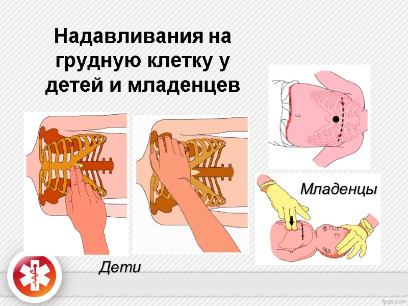 Надавливания на грудную клетку у детей и младенцев Дети Младенцы